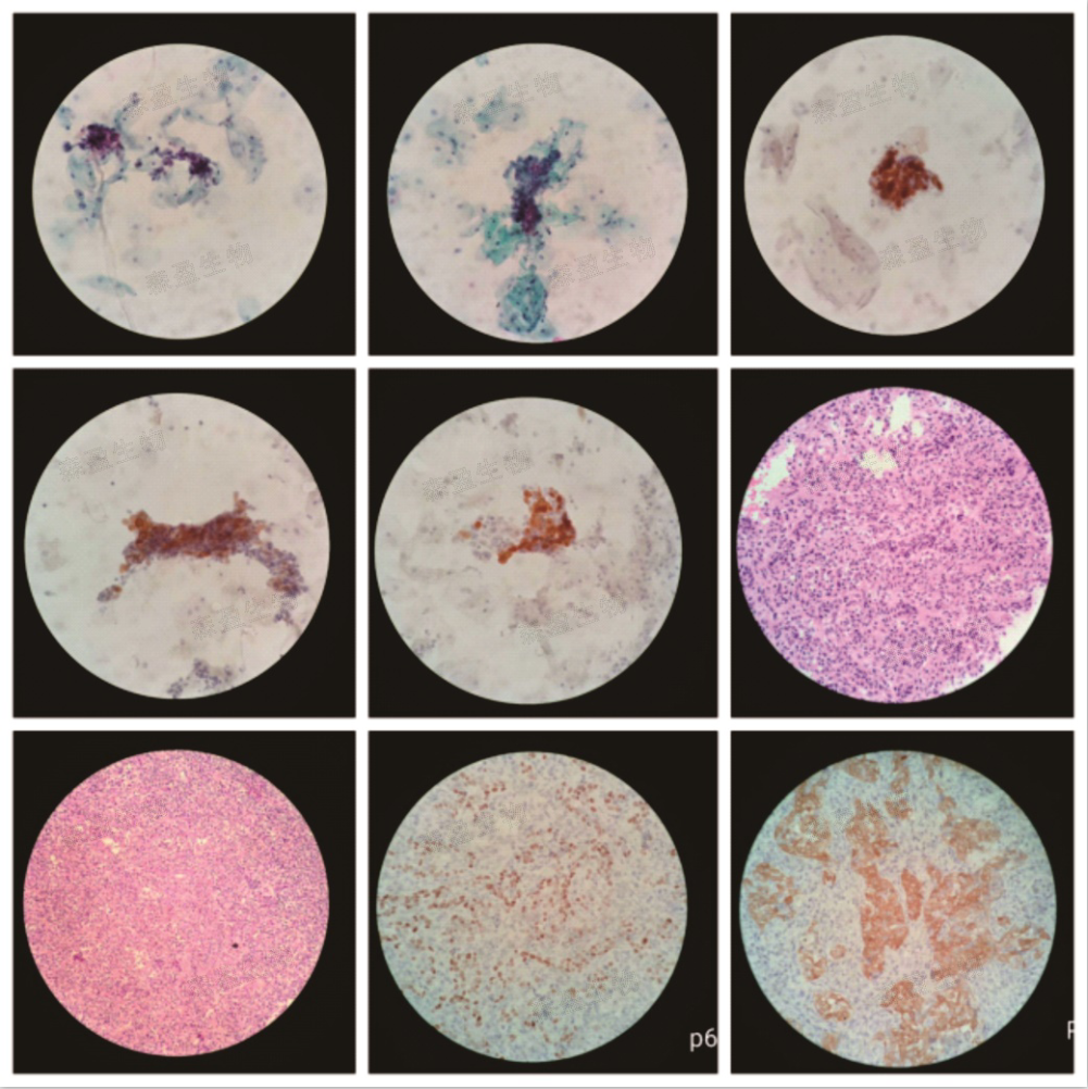 森盈生物p16染色临床案例:61岁:巴氏染色中病变细胞很不显眼,核改变不