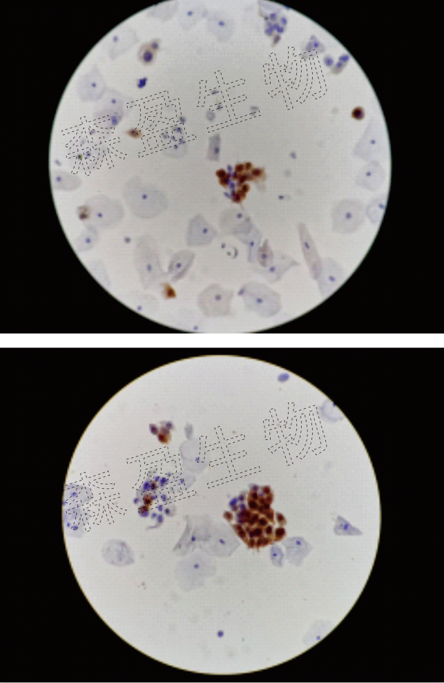 森盈生物p16染色临床案例34岁hsⅠl病变细胞核大深染大小不均核浆比